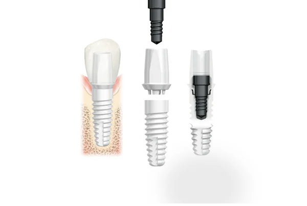 Conventional Implant