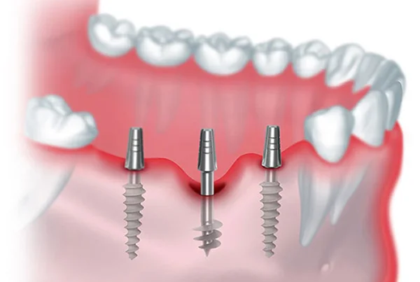 Maxillofacial Implants