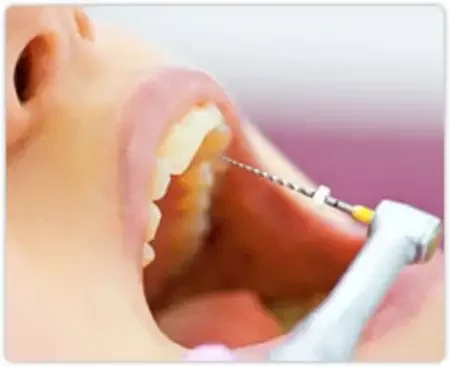 Single Sitting Root Canal Treatment