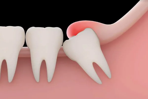 Third Molar Surgery
