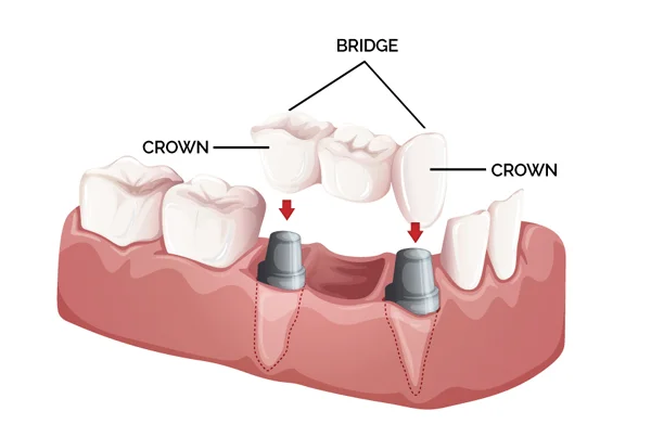 Crown n Bridges