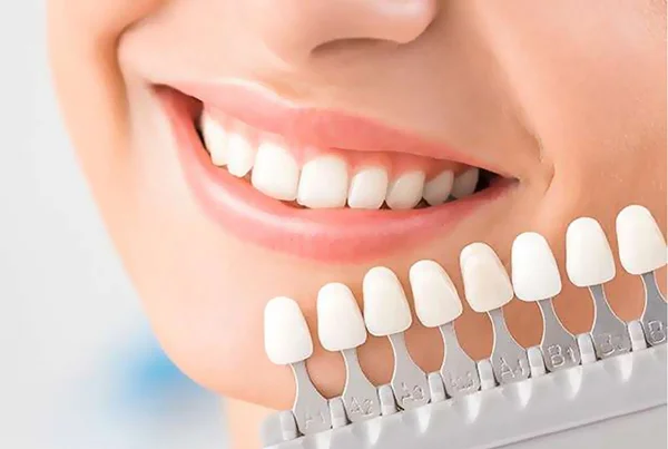 Laminates and Veneers