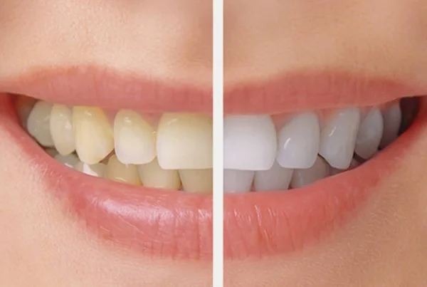 Teeth Bleaching